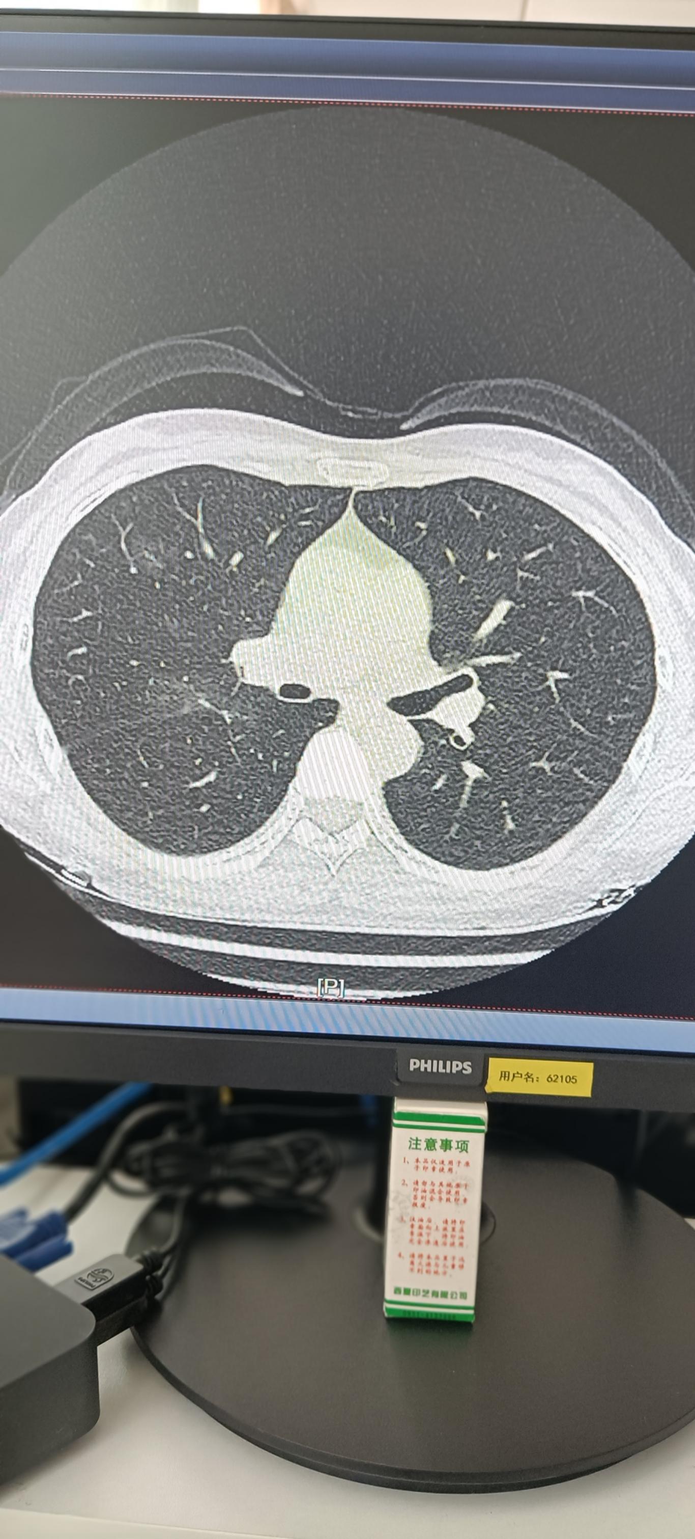 北京多名病例在返京途中感染.北京多名病例在返京途中感染怎么办-第1张图片